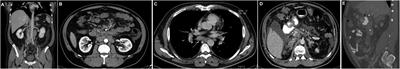 Renal metastasis of gastric cancer caused acute kidney injury which resulted with hemodialysis: case report and literature review